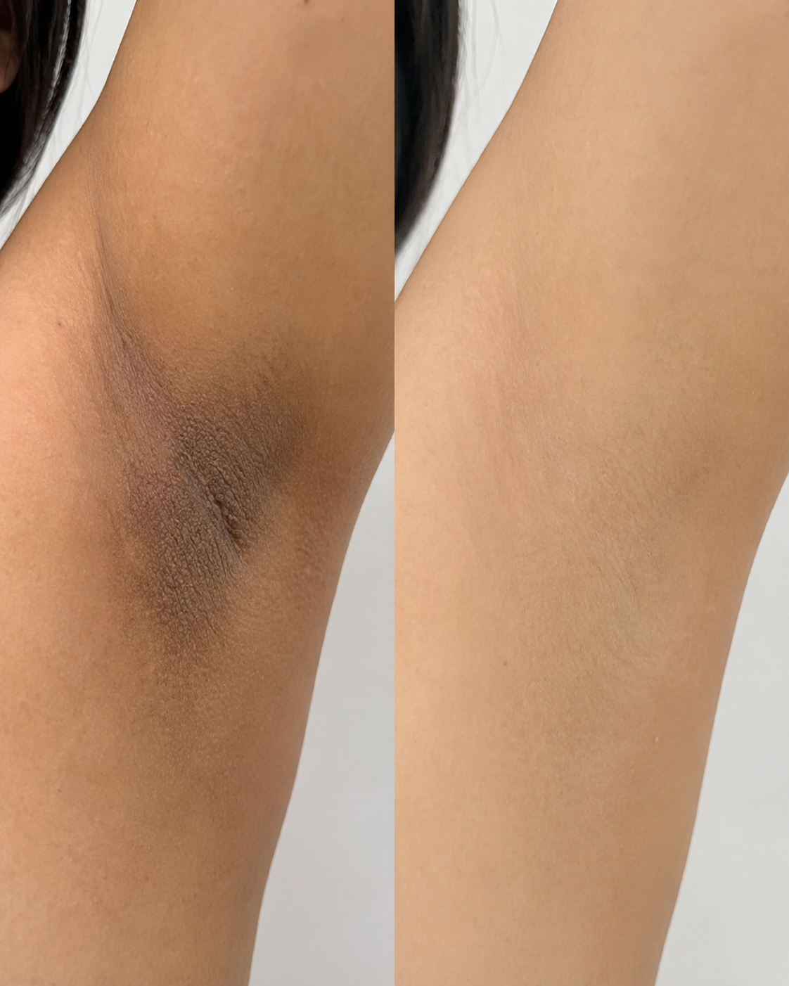 Before and after comparison of an underarm looking more even